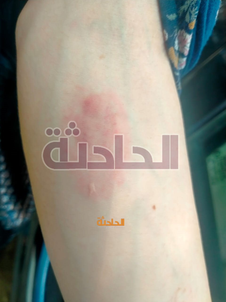 آثار التعذيب على يد نوران