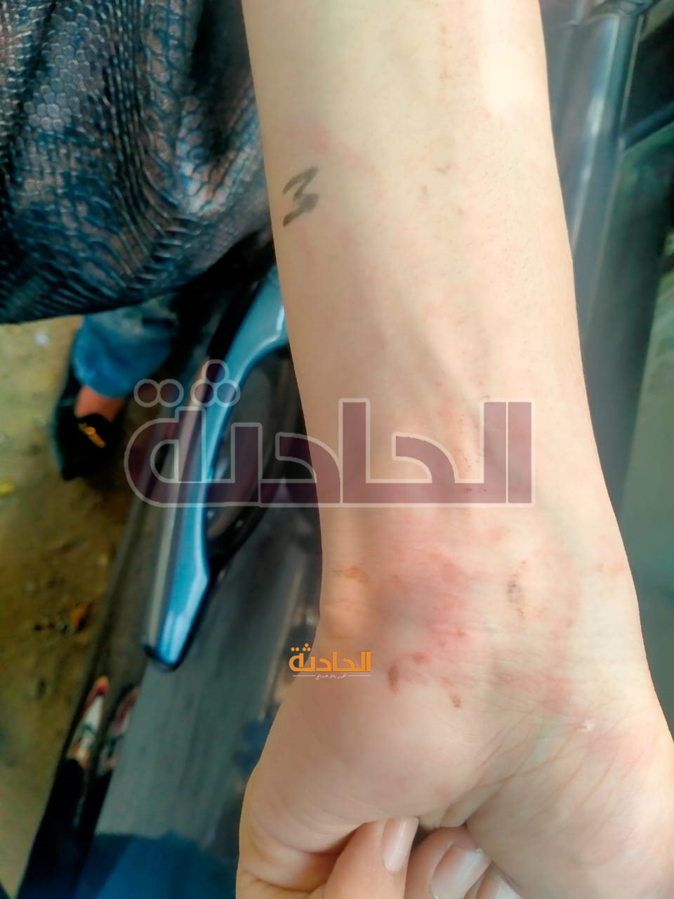 آثار التعذيب على يد نوران