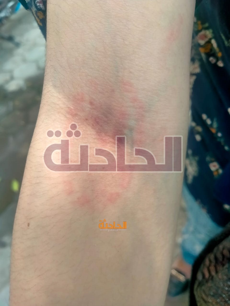 آثار التعذيب على يد نوران